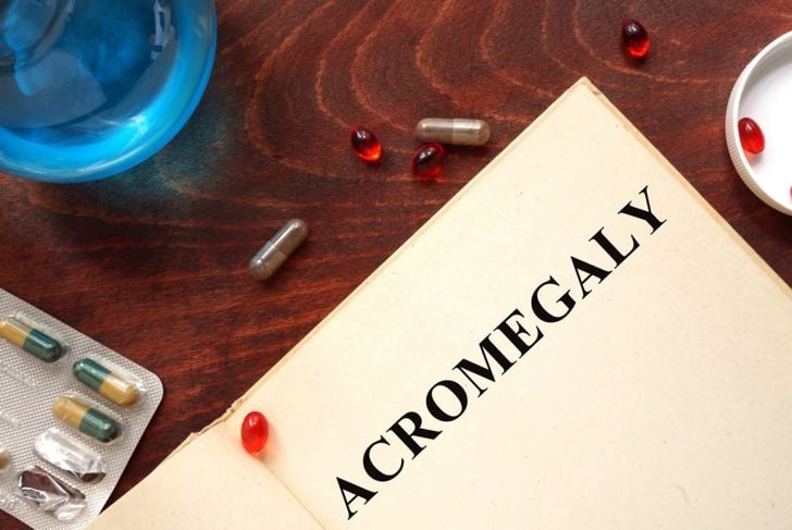 Che cos'è l'acromegalia? 11