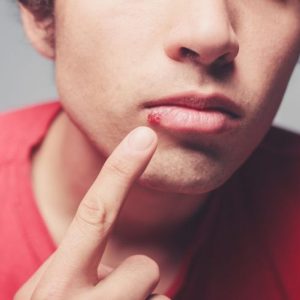 Le fasi dell’Herpes Labiale Le fasi dell’Herpes Labiale