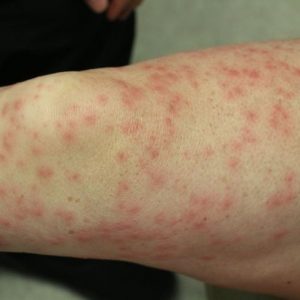 10 sintomi importanti della vasculite 10 sintomi importanti della vasculite