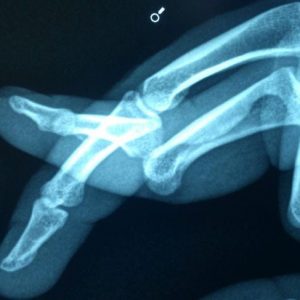 Tutto sulla lussazione del dito Tutto sulla lussazione del dito