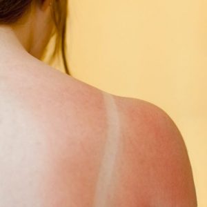 Ustioni di primo grado: Rischi, sintomi e trattamento Ustioni di primo grado: Rischi, sintomi e trattamento
