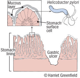 Ulcera peptica 4 Ulcera peptica 3