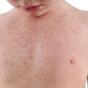 Che cos’è la mastocitosi? Sintomi e trattamenti Che cos’è la mastocitosi? Sintomi e trattamenti