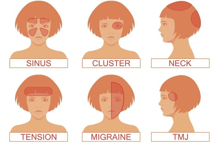 Guida al mal di testa: I diversi tipi di mal di testa 19