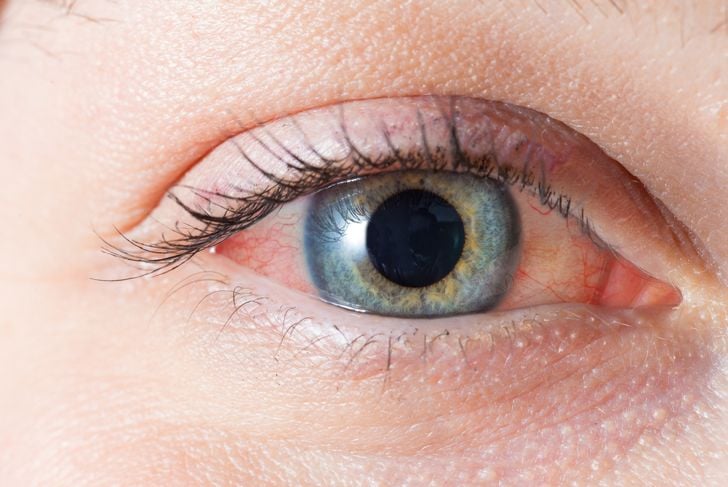 13 cause di occhi rossi 13