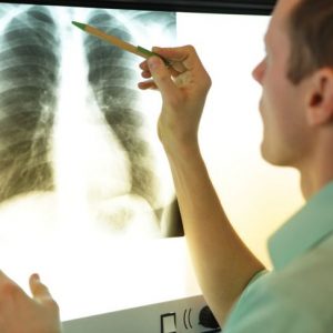 Cause, segni e trattamento della sindrome di Poland