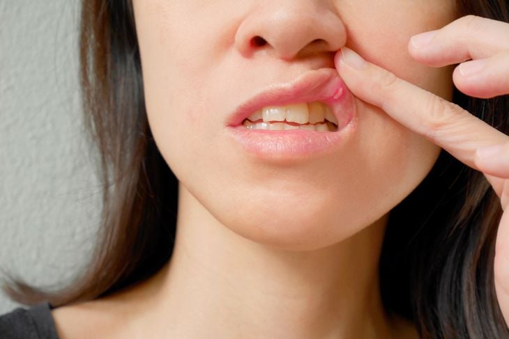 8 cause di un'ulcera della bocca 15