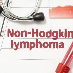 10 sintomi del linfoma non Hodgkin 10 sintomi del linfoma non Hodgkin