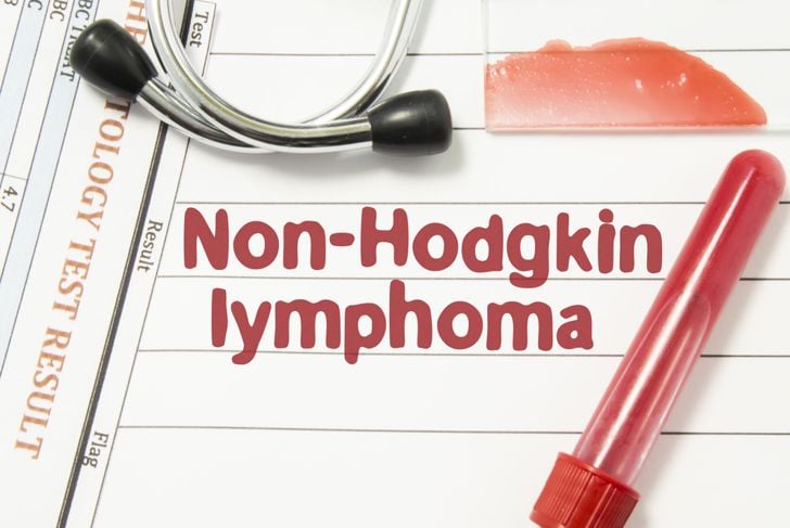 10 sintomi del linfoma non Hodgkin 1