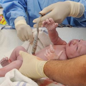 Infezioni dell’ombelico nei neonati