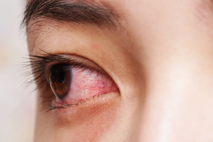 10 cause di glaucoma 19