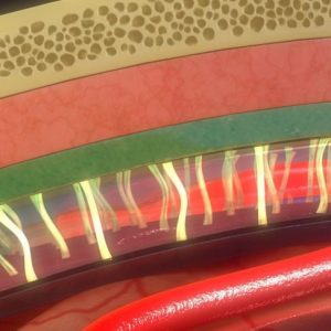 Cause, sintomi e opzioni di trattamento dell’aracnoidite