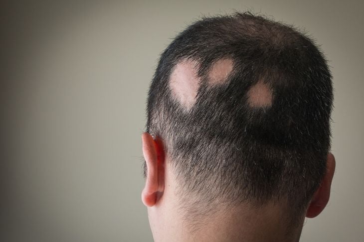 Che cos'è l'alopecia areata? 7