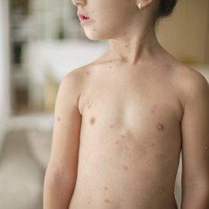 10 sintomi della varicella