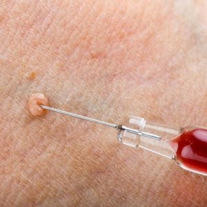 10 Sintomi e trattamenti delle verruche anali 10 Sintomi e trattamenti delle verruche anali
