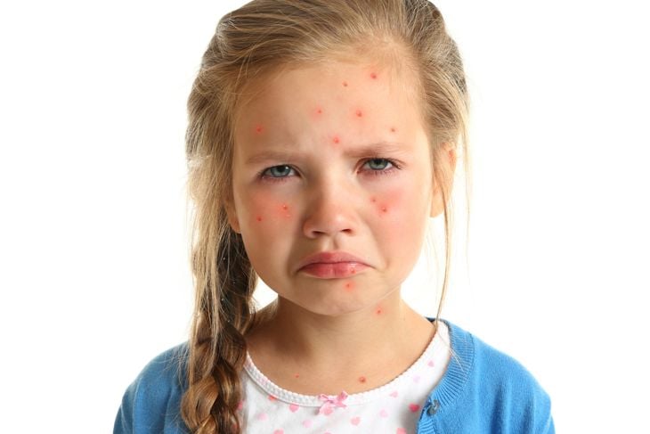 Che cos'è la varicella? Sintomi e trattamento 3