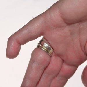 10 Sintomi e trattamenti del dito maligno 10 Sintomi e trattamenti del dito maligno