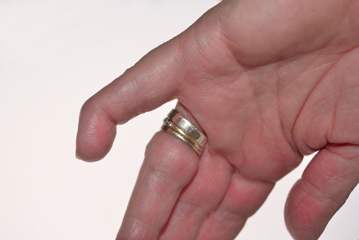10 Sintomi e trattamenti del dito maligno 1