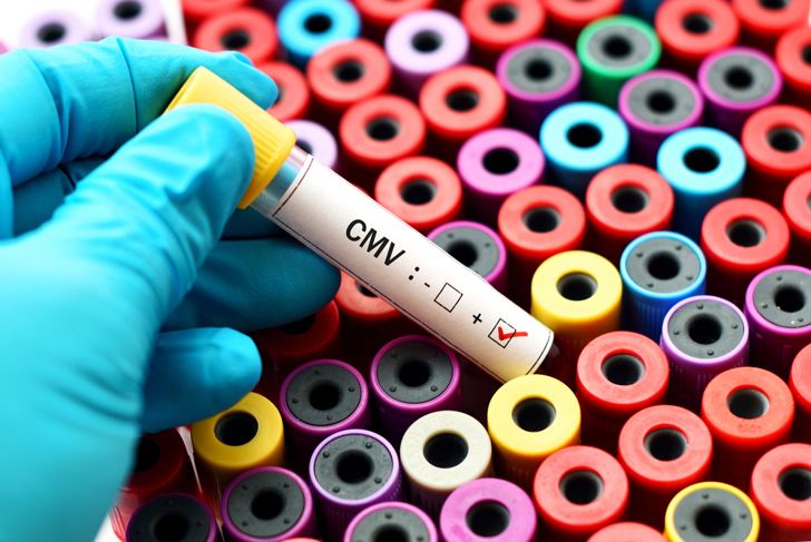 10 sintomi del citomegalovirus (CMV) 1
