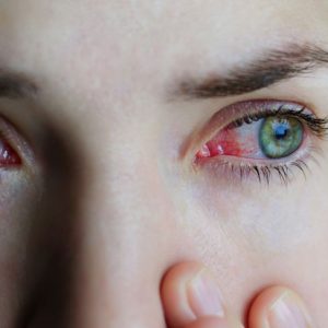 13 cause di occhi rossi