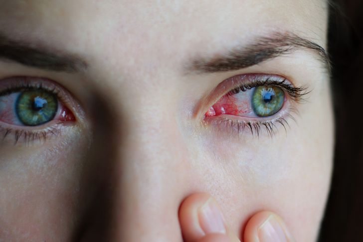 13 cause di occhi rossi 1