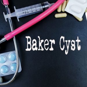 Cisti di Baker: sintomi e trattamenti Cisti di Baker: sintomi e trattamenti