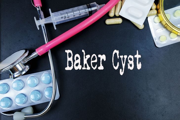 Cisti di Baker: sintomi e trattamenti 1