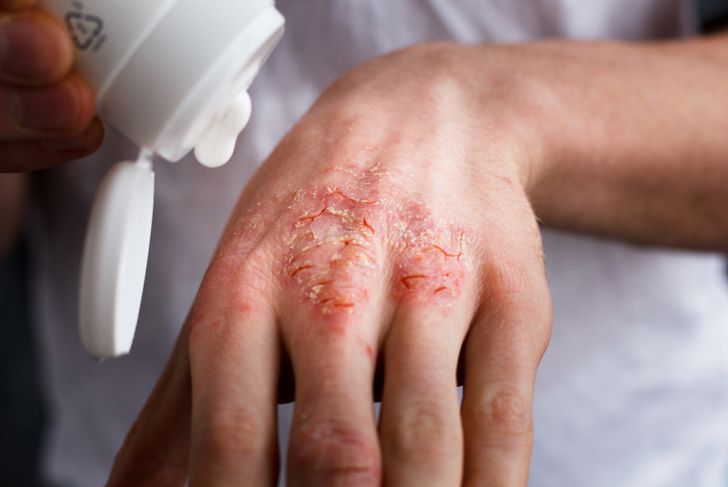 Domande frequenti sulla dermatite da contatto 15