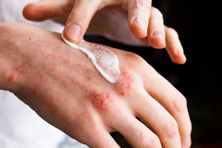 10 cause e fattori scatenanti dell'eczema 19