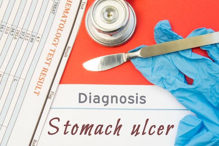 10 trattamenti popolari per l'ulcera allo stomaco 1