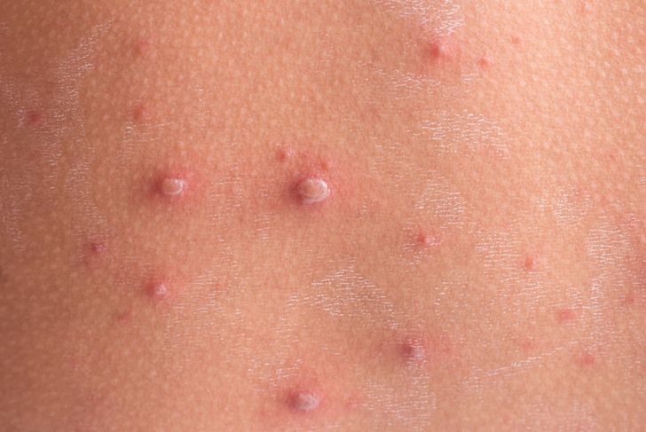 Che cos'è la varicella? Sintomi e trattamento 7