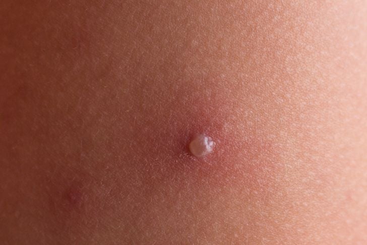 10 sintomi della varicella 5