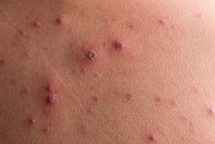 10 sintomi della varicella 7