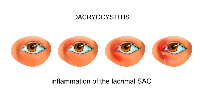Infezione del dotto lacrimale (dacriocistite)