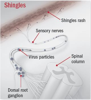 Herpes zoster 4 Herpes zoster 3
