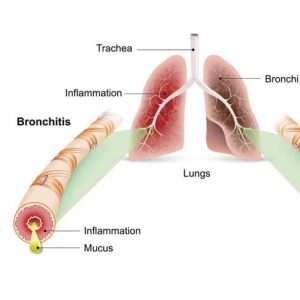 Cause della bronchite