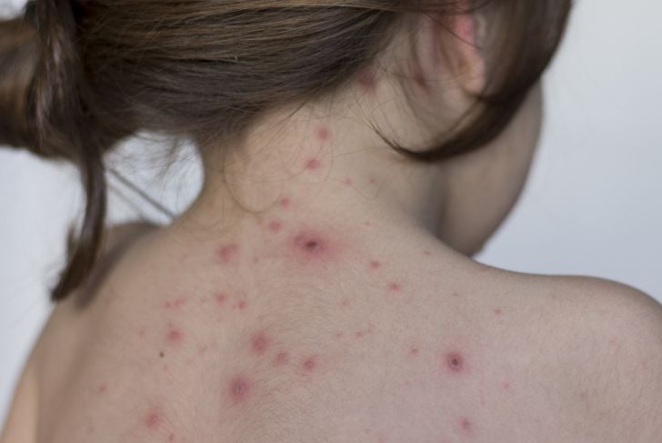 Che cos'è la varicella? Sintomi e trattamento 9