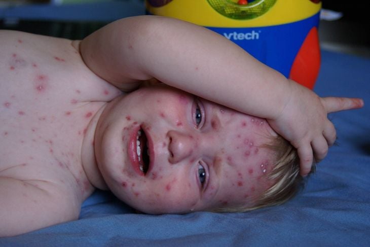 Che cos'è la varicella? Sintomi e trattamento 5