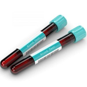 Cosa significano i risultati degli esami del sangue? Cosa significano i risultati degli esami del sangue?