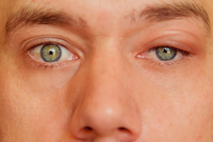 10 cause di contrazione degli occhi 9