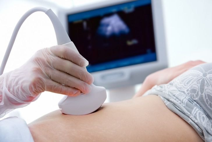10 domande frequenti sui polipi uterini 5