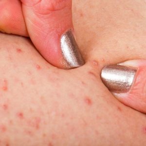 Sintomi e trattamenti per la Miliaria