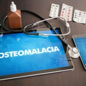 Domande frequenti sull’osteomalacia