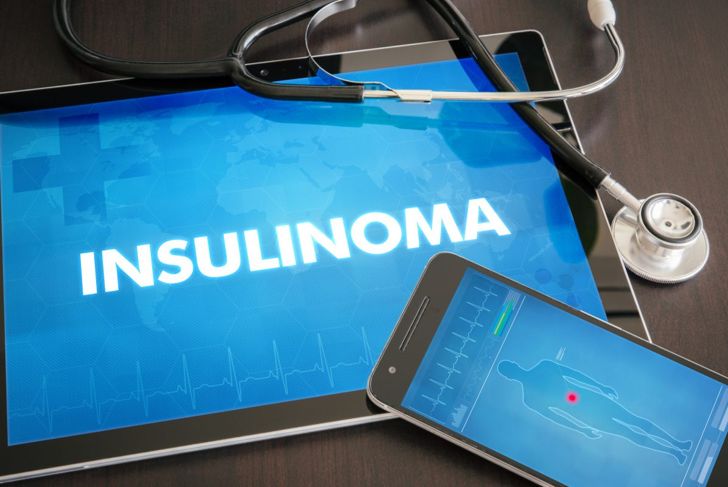 Insulinomi: tumori benigni del pancreas 1
