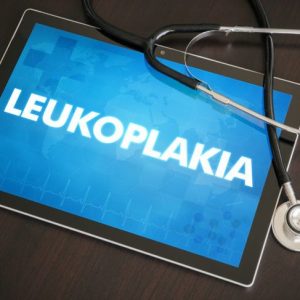 Che cos’è la leucoplachia? Che cos’è la leucoplachia?