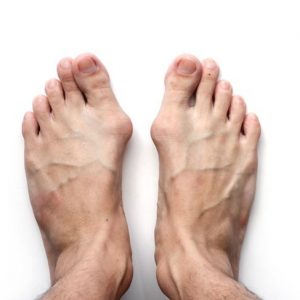 10 Sintomi e trattamenti dell’alluce valgo 10 Sintomi e trattamenti dell’alluce valgo
