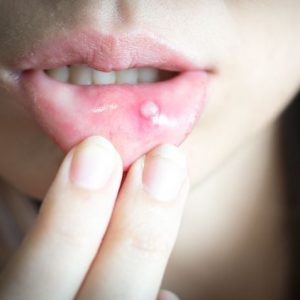 8 cause di un’ulcera della bocca