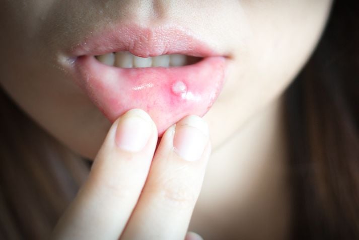 8 cause di un'ulcera della bocca 1