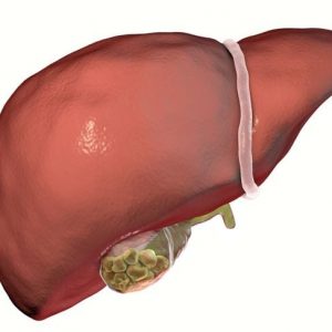 10 Sintomi e trattamenti dei calcoli vescicali 10 Sintomi e trattamenti dei calcoli vescicali