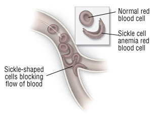 Anemia falciforme 1